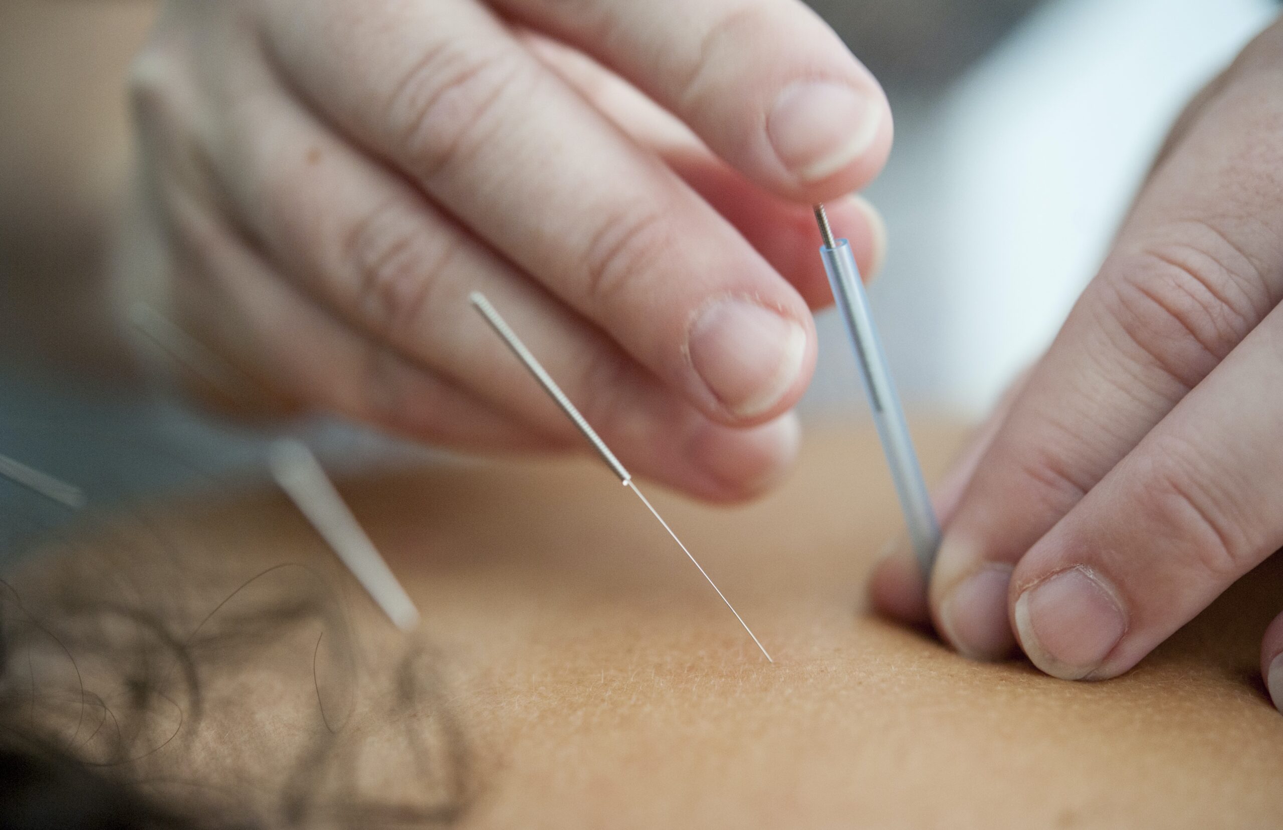 Can Acupuncture Provide Relief For Sacroiliac Joint Discomfort?